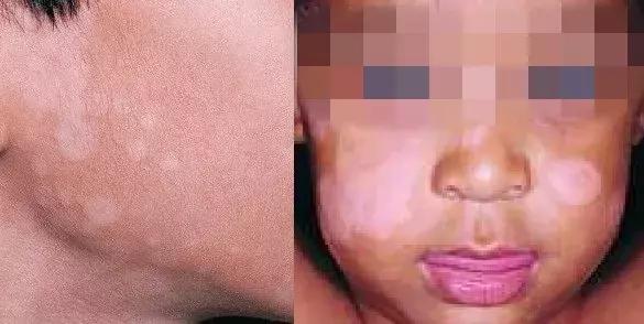 儿童脸上长白斑缺什么微量元素,宝宝脸上长白斑是怎么回事