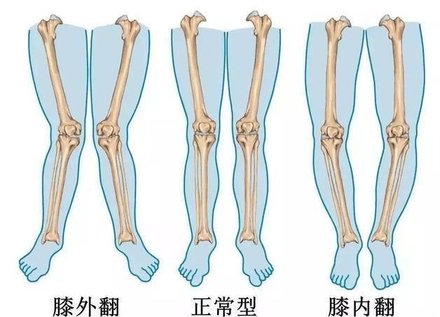关节炎？走路痛？洋葱这样用，“赶”走膝盖痛！快学起来~