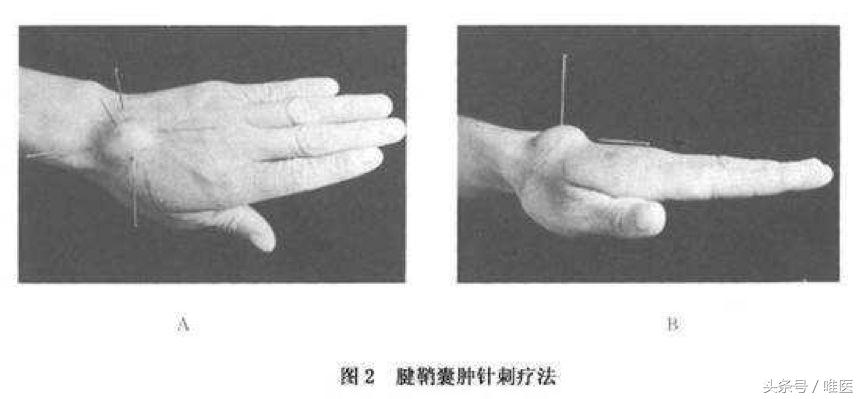 手腕处有个突出的包是腱鞘囊肿吗,手腕干活累的出现腱鞘囊肿怎么办