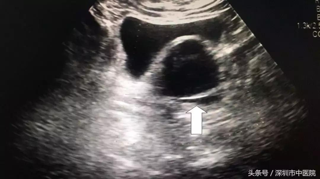 「康复案例」有肿瘤却又想做不留疤的手术,我也是拼了……