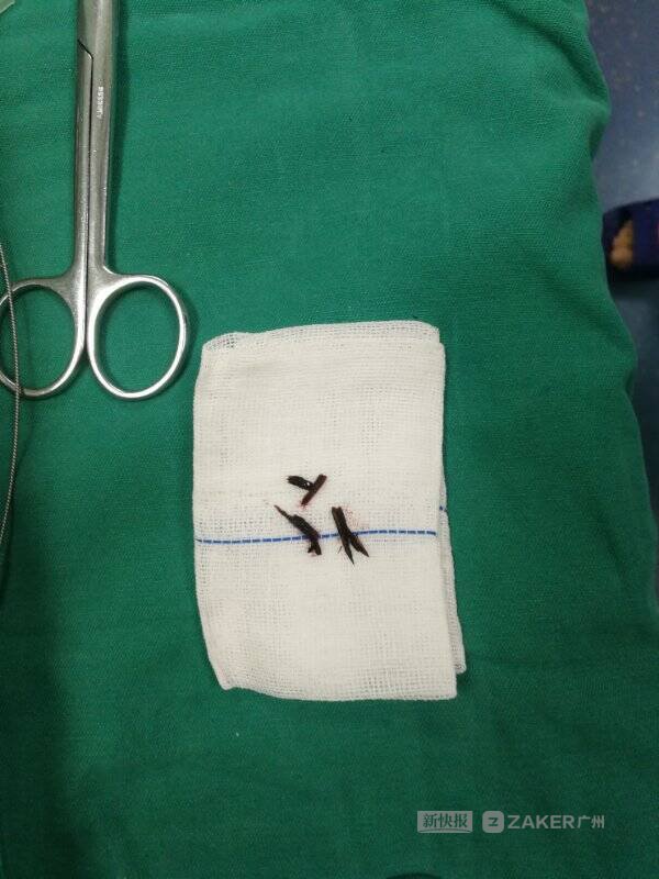 眼睛红肿化脓挡住瞳孔,眼睛进异物发炎流脓