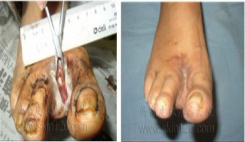 糖尿病下肢介入手术后注意事项,糖尿病下肢发凉怎么治疗