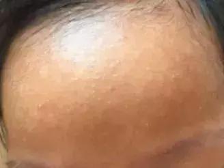 宝宝长小疹子后溃烂,宝宝的红疹子溃烂了