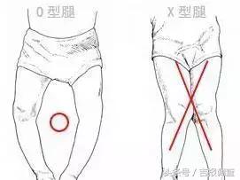 婴儿缺钙腿会长不直吗,婴儿腿不直怎么治最有效