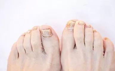 糖尿病足的皮肤,糖尿病足早期信号