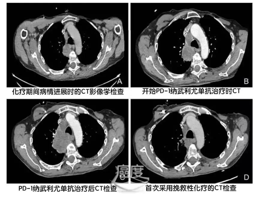 pd-1与其他化疗药可以同用吗,pd1耐药后化疗再次耐药