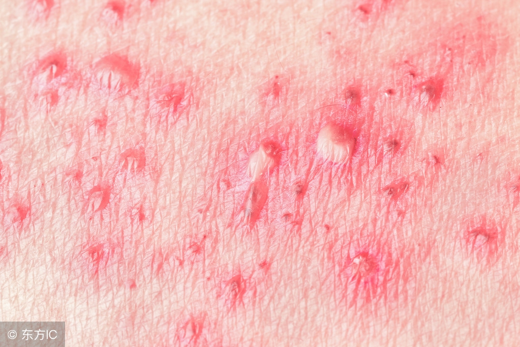 你不应该忽视的女性疱疹症状