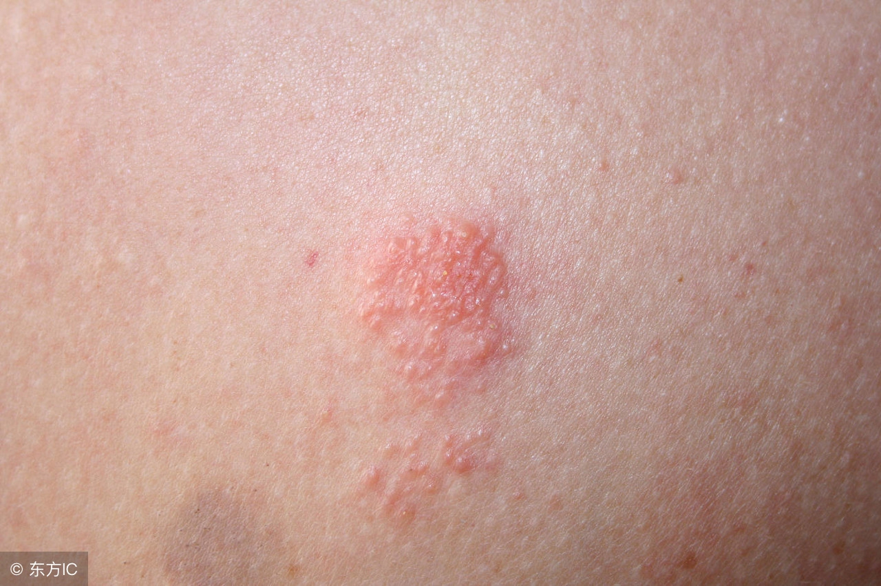 你不应该忽视的女性疱疹症状