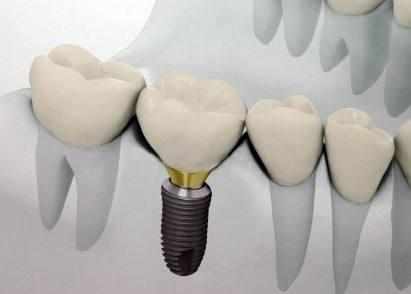 镶牙和种牙的区别种植牙的危害,种植牙的利与弊能镶牙就不要种牙