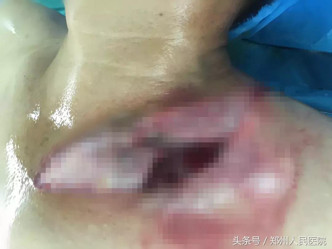 凶险！农民工左胸砸了个“大窟窿”，险些一命呜呼！