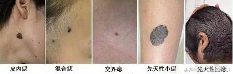 容易一碰就出血的痣是怎么回事,痣出血血流不止
