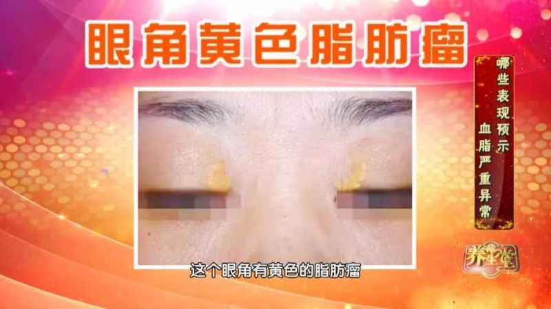 警惕血脂异常的3个信号,血脂异常的十大征兆