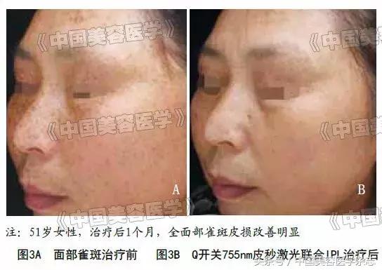 q开关激光祛斑效果,q开关激光祛斑怎么样