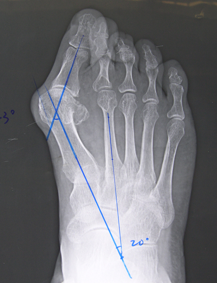 女儿遗传了妈妈的大脚骨,女孩大跟脚大遗传有关吗
