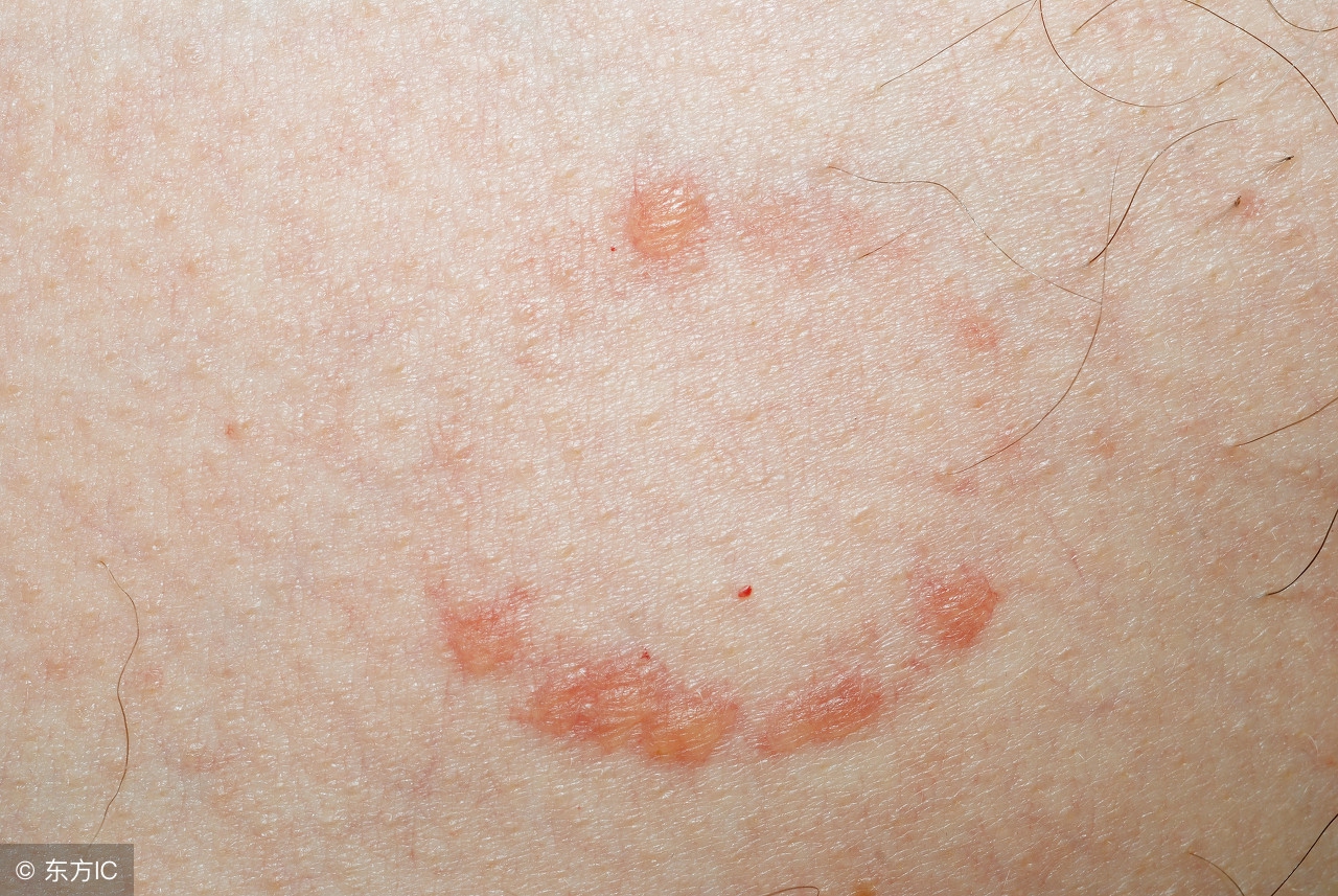 什么是生殖器疱疹与病毒感染有关吗？