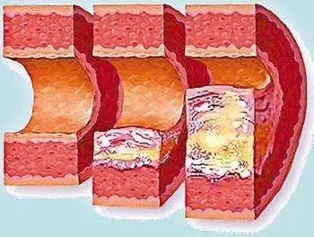 腿抽筋是缺钙引起的吗,腿抽筋是缺钙吗究其原因都有哪些