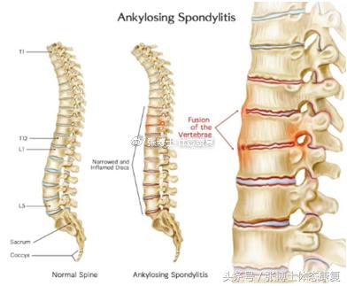 运动康复科普强直性脊柱炎,强直性脊柱炎腰部锻炼康复方法