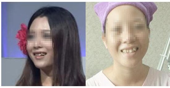 种植牙能降价多少钱啊,牙齿种植牙价格一览表