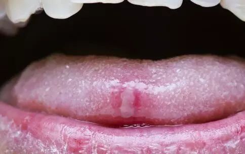 中医认为口腔溃疡发病的原因,口疮和舌癌区别