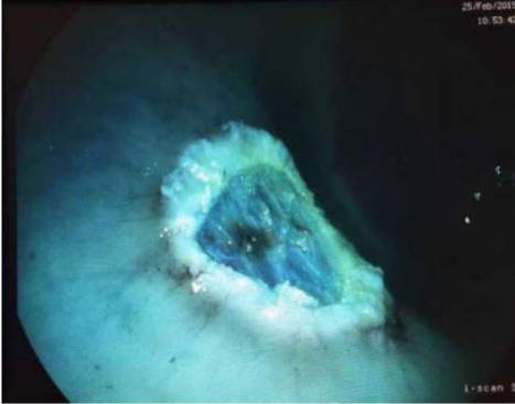 当内镜遇到情人节……