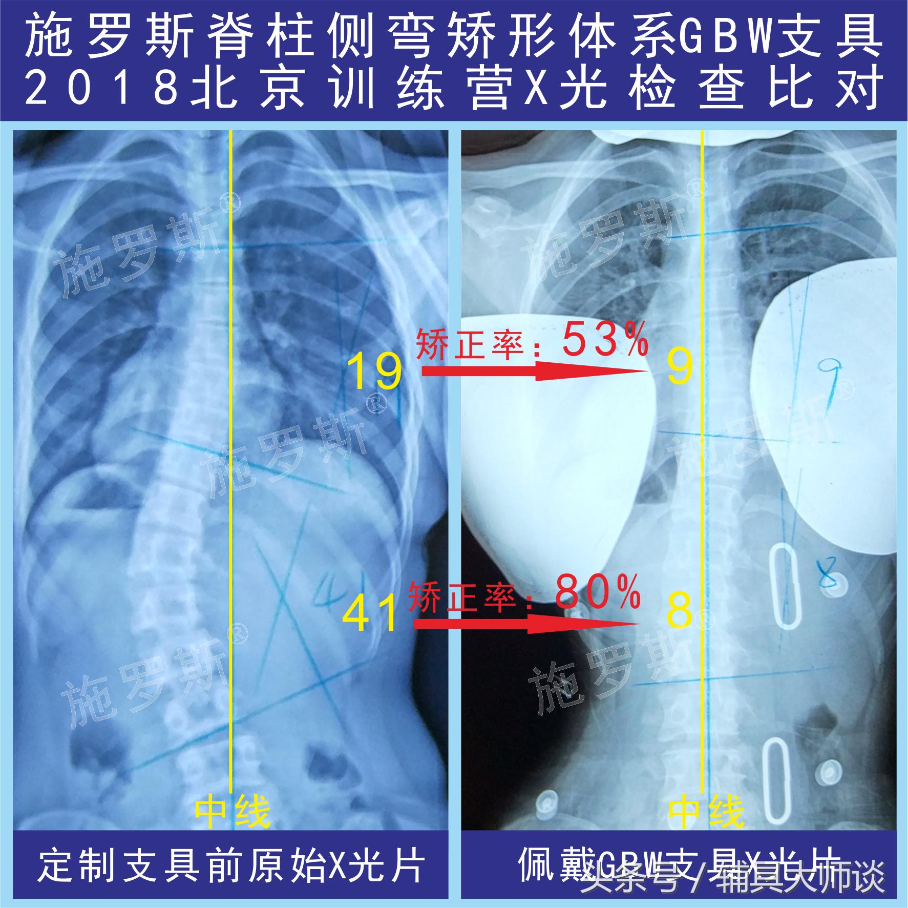 德国gbw支具侧弯60度适合吗,德国gbw支具北京哪里可以订