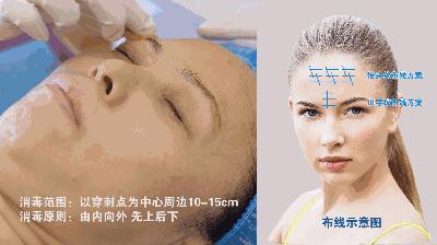 不埋线面部线雕全过程,线雕提拉术知识大全