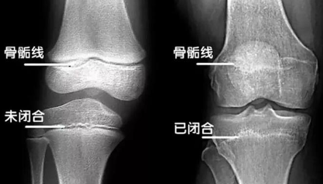 4岁女儿骨龄只有2.5岁,医生让去指定药店买药,可太贵了