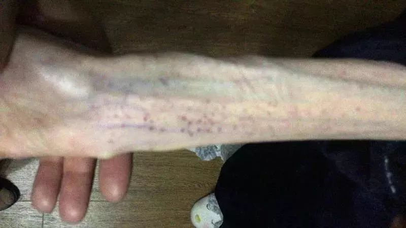 「微提醒」“自杀式”减肥要不得！21岁女孩体重竟然只有50斤！