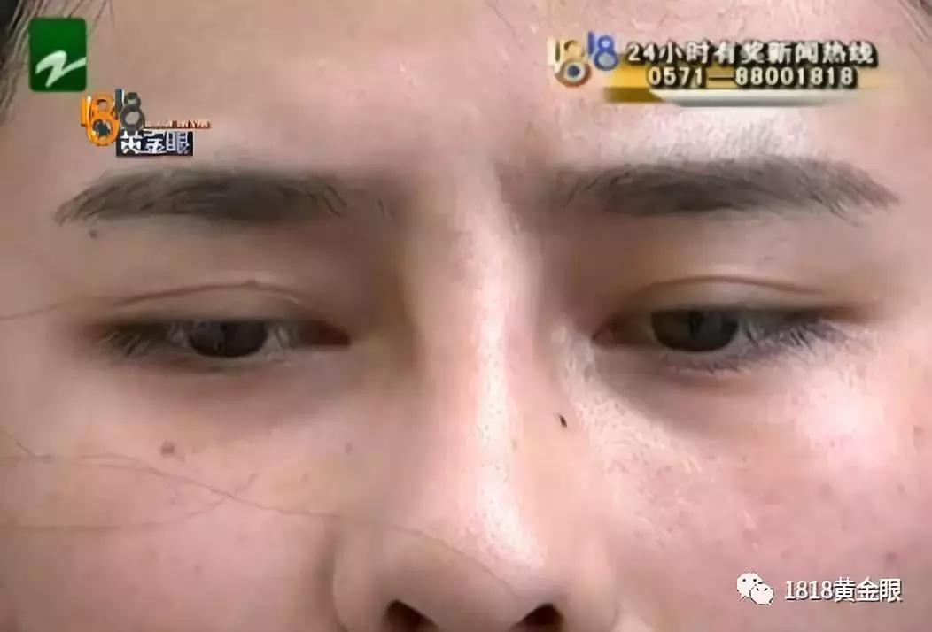 脸上有个小洞一直流脓,脸上有一个毛孔反复化脓结痂