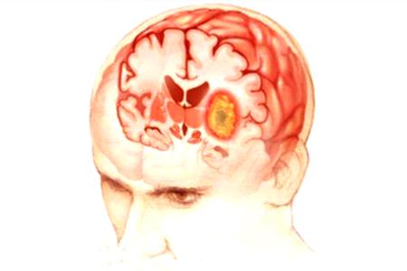 母细胞胶质瘤症状,儿童视神经胶质瘤症状