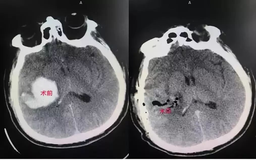 「技术硬实力」不断创新发展的玉田县中医医院脑病四科！