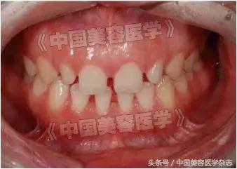 牙齿缝隙太大怎么补救吃什么,牙齿缝隙太大怎么快速补救