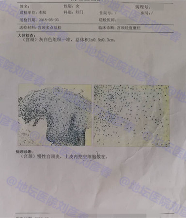 宫颈切除hpv持续感染怎么办,宫颈病变切除后hpv16阳性