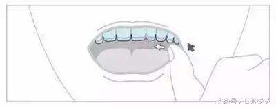 隐形牙套佩戴注意事项,替牙期隐形牙套佩戴管理