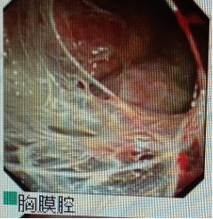 胸水为什么会抽不到,胸水抽了为什么还呼吸困难