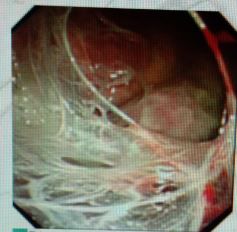 胸水抽了为什么还呼吸困难,胸水抽不出来了怎么回事