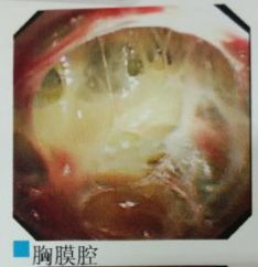 胸水为什么会抽不到,胸水抽了为什么还呼吸困难