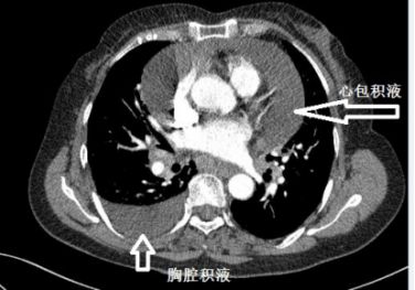 胸水为什么会抽不到,胸水抽了为什么还呼吸困难