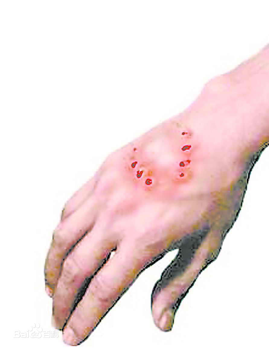 狂犬病死亡率达到100%,狗有狂犬病毒咬人后能活多久