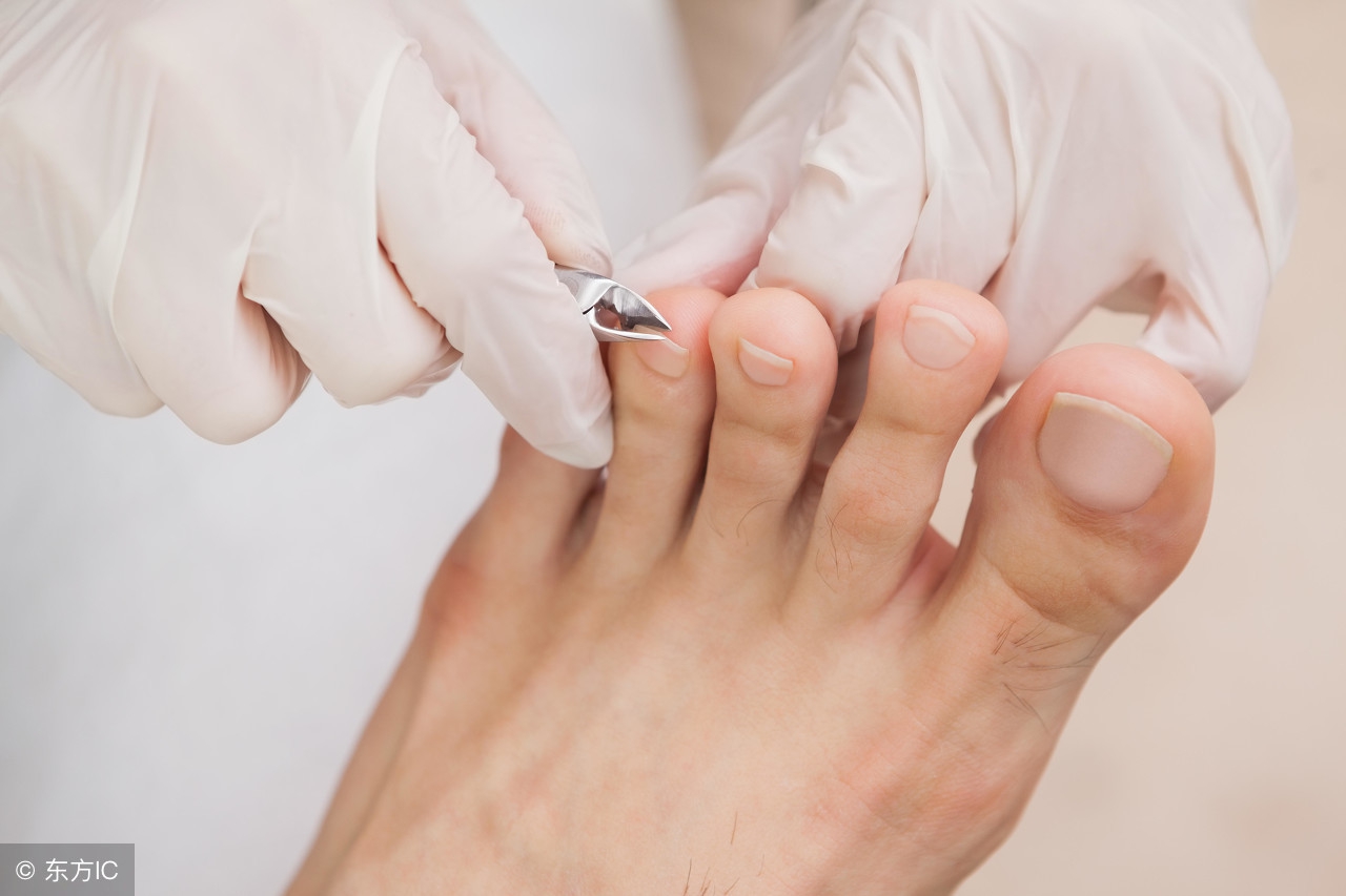 冬季脚脱皮有脚气怎么办,去脚气脚脱皮的小妙招