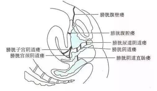 25岁辣妈小便时出现“*管双**齐下”的现象，她到底怎么了？