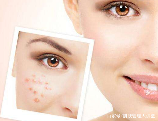 挤痘痘一挤就出血,挤痘一瞬间头晕