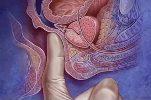 直肠癌和痔疮的便血鉴别,直肠癌与大肠癌的鉴别