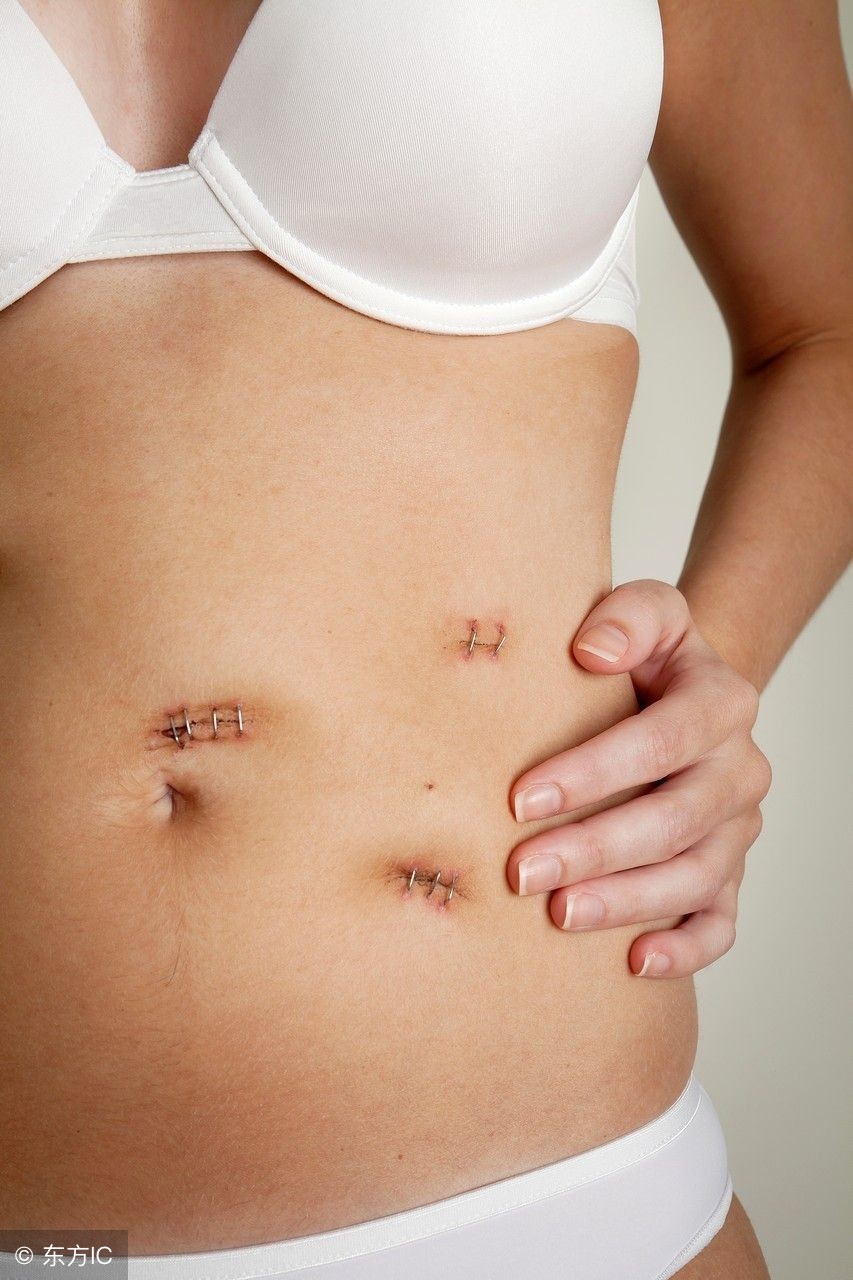 为什么妇科医生多建议手术患者选择腹腔镜手术?