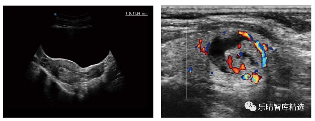 彩超发展到几代了,彩超技术发展史