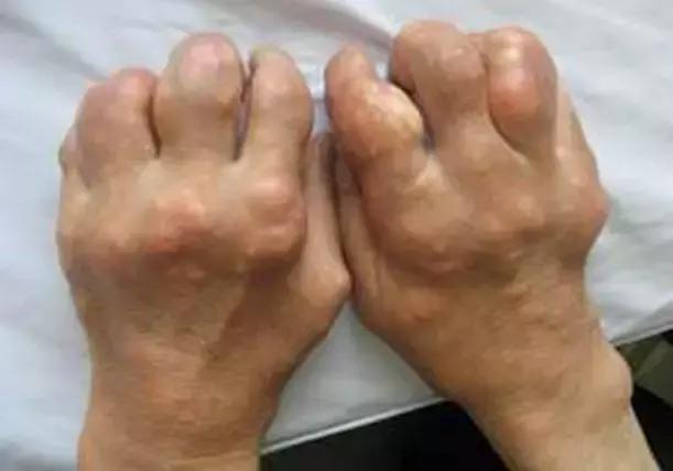 健康生活|看着就痛!36岁的他,双手双脚上都长满“石头”