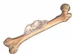 得了骨肿瘤怎么办,得了良性骨肿瘤还能买保险了吗