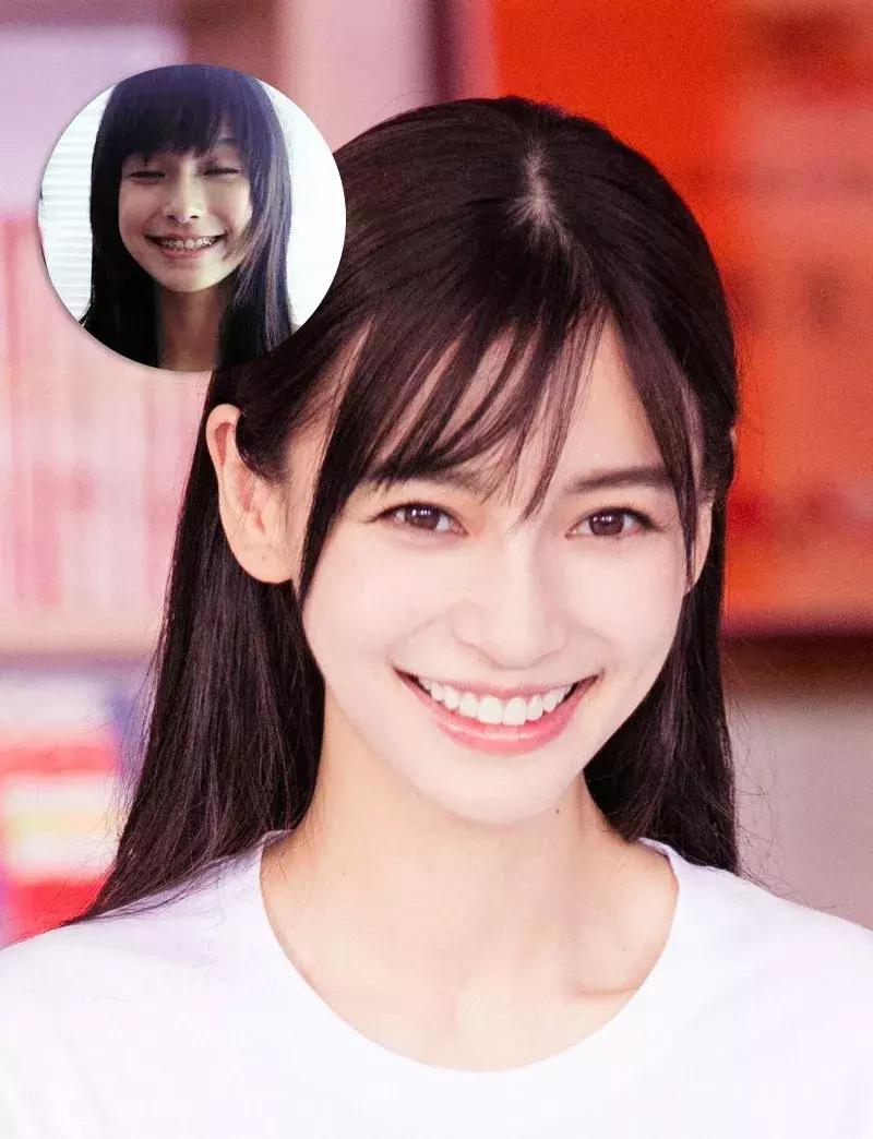 还在犹豫是否整牙，明星们默默变美都在靠它，你想知道的这篇都有