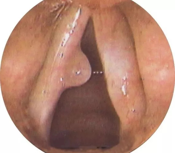 肠息肉和胆囊息肉必须做手术吗,肠息肉切除好还是不切除好