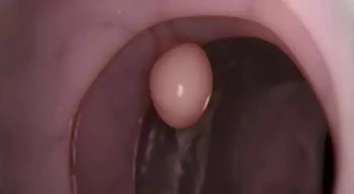 肠息肉和胆囊息肉必须做手术吗,肠息肉切除好还是不切除好